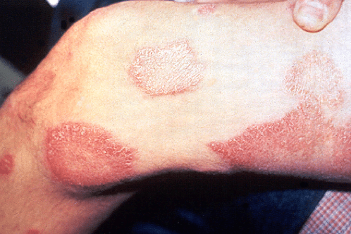 Hanseníase (Foto: US.department of health and human services/Wikimedia Commons)